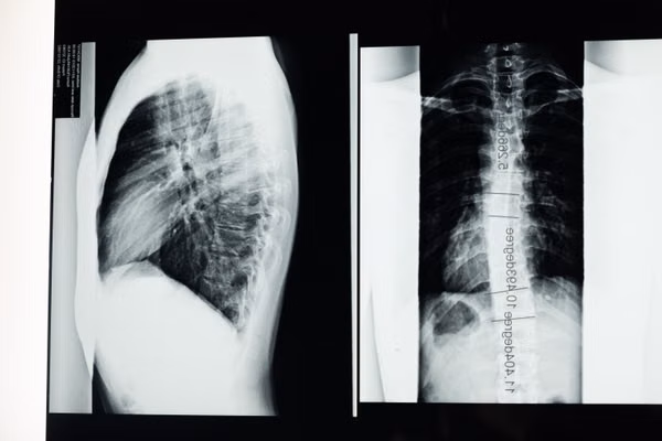 ICU Ventilator — 3